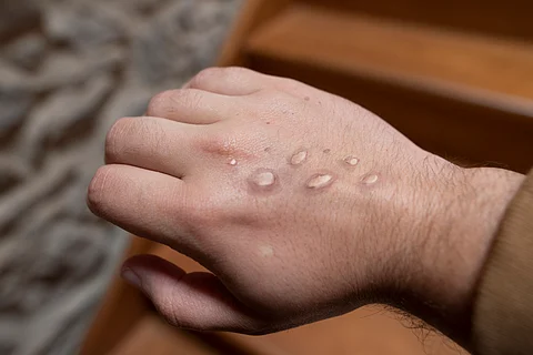 Mpox vesicles on a hand.