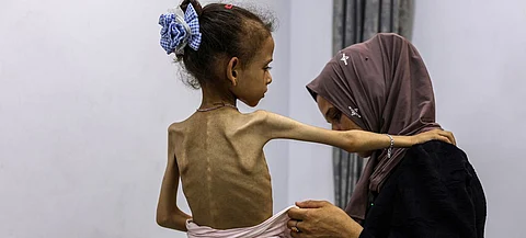 A severely malnourished girl in Gaza.
