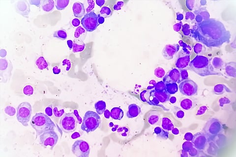 बोन मैरो स्लाइड का माइक्रोस्कोपिक व्यू जिसमें मल्टीपल मायलोमा दिखाया गया है, जिसे मायलोमा भी कहते हैं, यह एक तरह का बोन मैरो कैंसर है। फोटो: आईस्टॉक