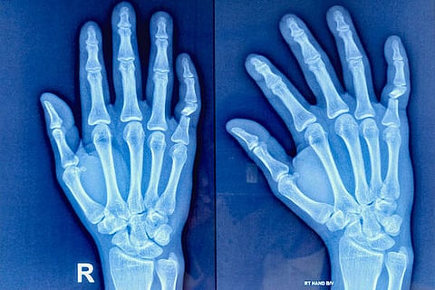 सोरायसिस से पीड़ित लगभग 20 से 30 प्रतिशत लोगों में आगे चलकर सोरायटिक आर्थराइटिस विकसित हो सकता है।