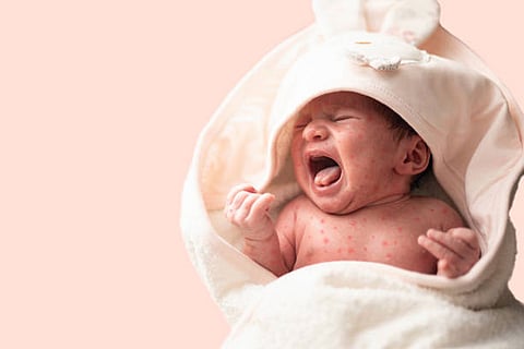 बांग्लादेश में टीकों की कमी और टीकाकरण कार्यक्रम में देरी को इस खतरनाक प्रकोप का मुख्य कारण बताया जा रहा है।