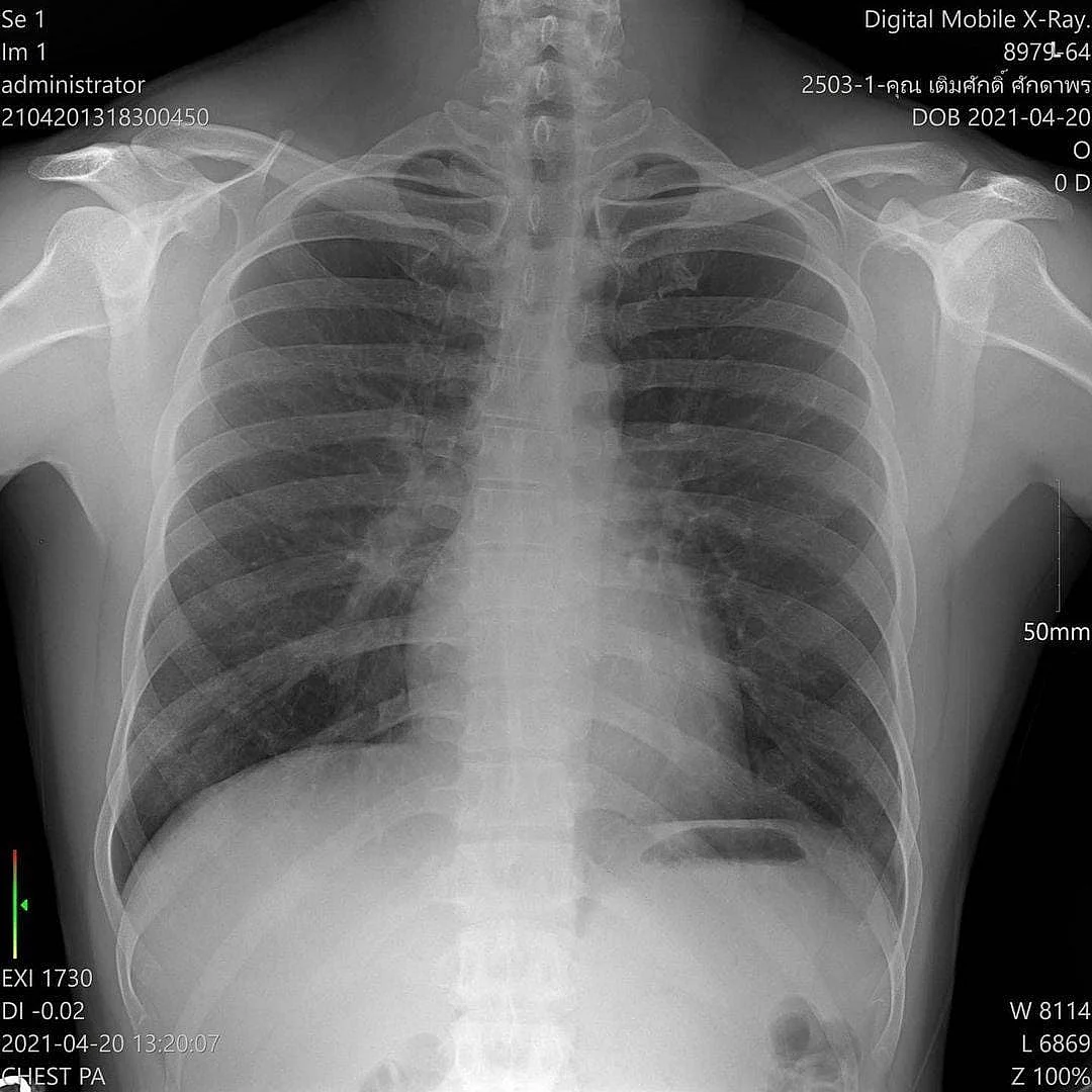 ภาพX-ray ปอด ของสามีอีฟ