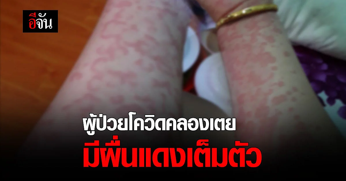 ผู้ป่วยคลองเตย มีผื่นแดงขึ้นเต็มตัว และมีอาการแน่นหน้าอก