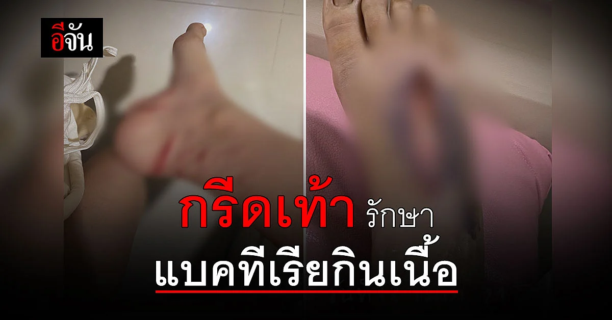 อุทาหรณ์ ทาสแมว ! สาวถูก แมวกัดเท้า ทำติดเชื้อ แบคทีเรียกินเนื้อ