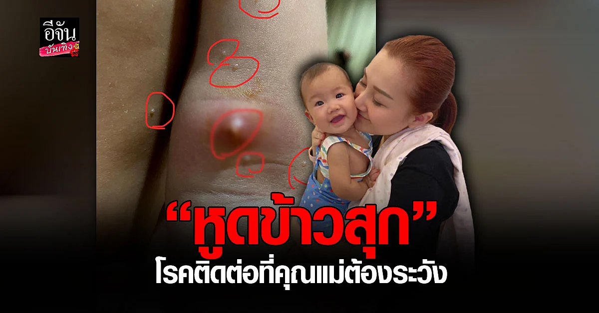 เอ็ม บุษราคัม สุดห่วงลูกสาว น้องณเวฬา เป็น หูดข้าวสุก