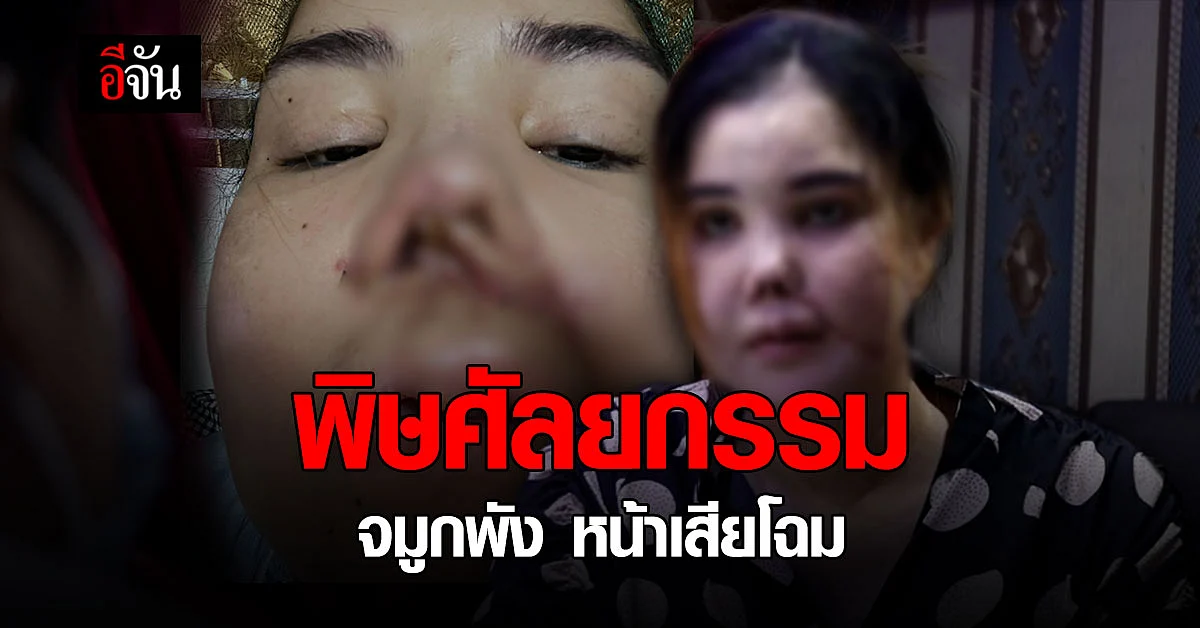สาวสุดช้ำ แก้ จมูกพัง ทำหน้าเสียโฉม ซ้ำ โดนดูหมิ่นว่า พิการ