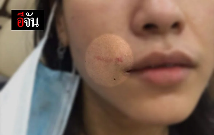 รอยแผลบนใบหน้า ของสาวบนรถเมล์