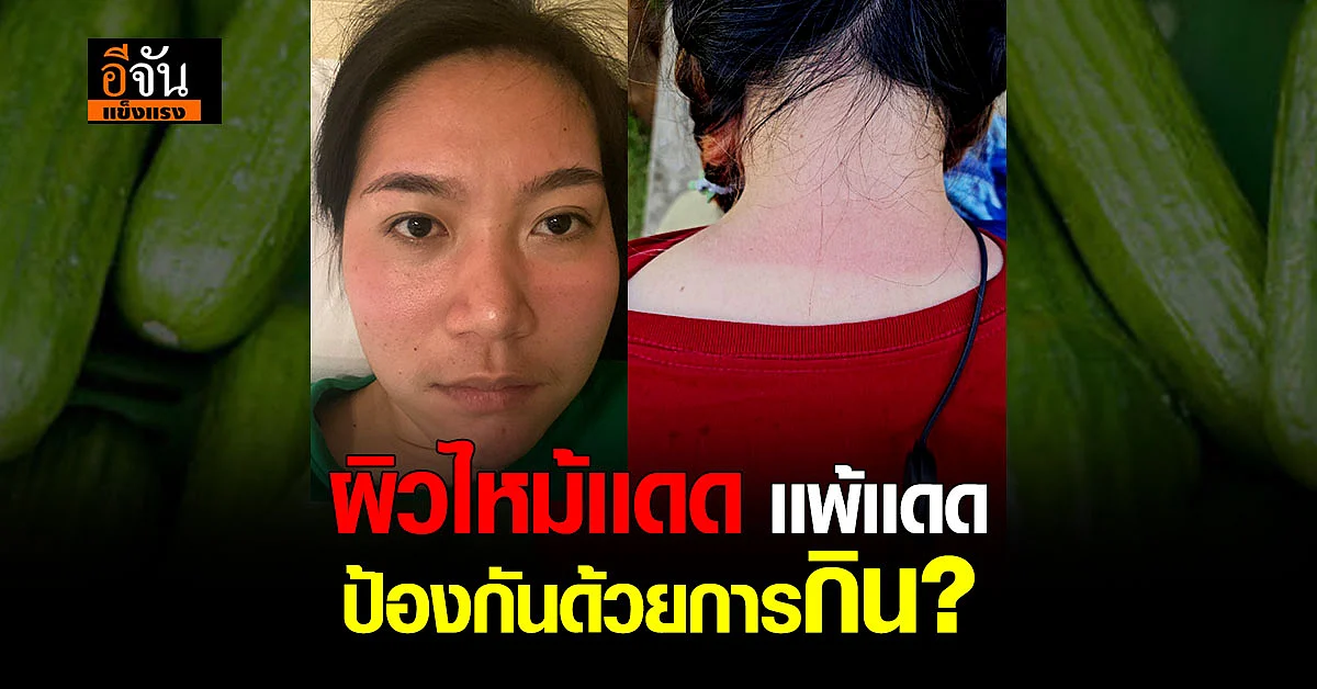 ผิวไหม้เเดด ทากันเเดดเเล้วเอาไม่อยู่ ปรับการกินช่วยได้นะ