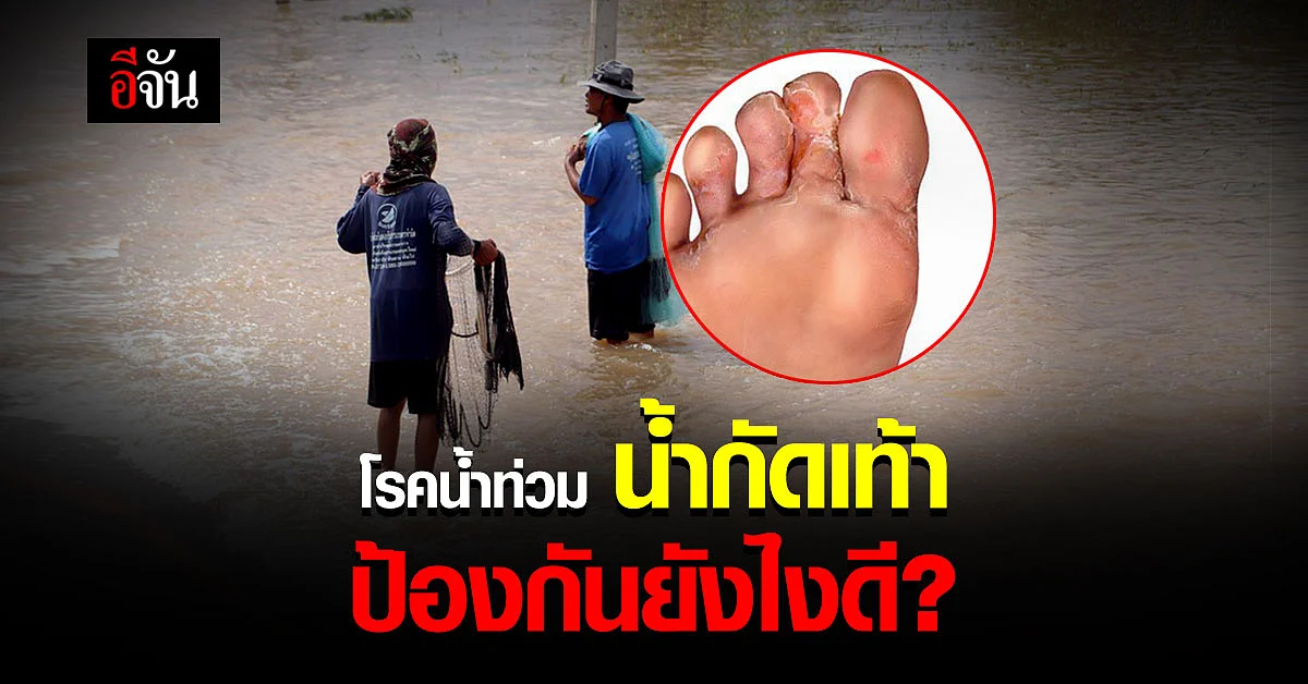 เลี่ยงไม่ได้ ลุยน้ำ จนน้ำกัดเท้า ป้องกัน เเละรักษายังไงดี