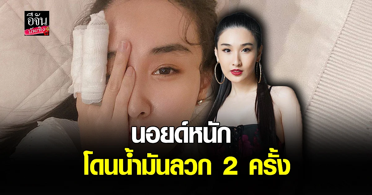 กระติ๊บ เล่าเหตุการณ์โดน น้ำมันลวก พร้อมเปิดใจเรื่อง ความรัก 10 ปี