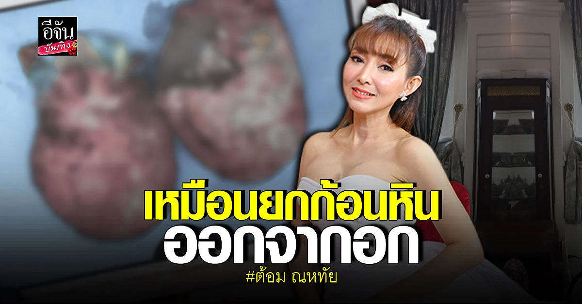 ต้อม ณหทัย ผ่าตัดเสริมอึ๋มใหม่ ขนาด 375 cc