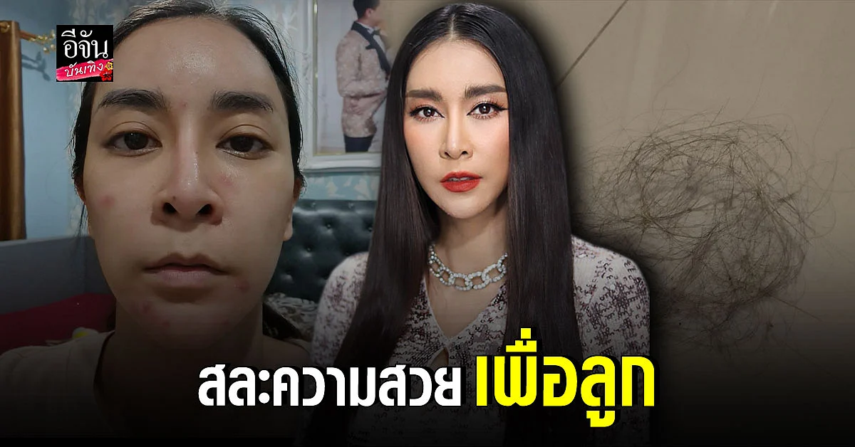 ใหม่ สุคนธวา เผย แพ้ท้อง หนักกว่าท้องแรก เป็นสิวหนักมาก