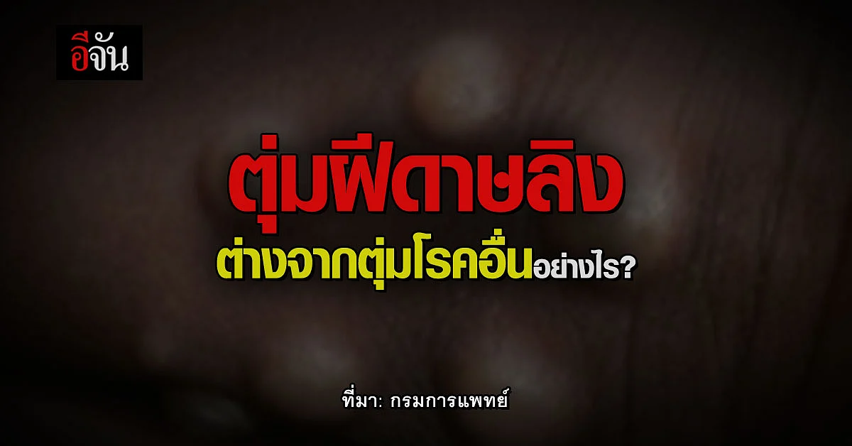 กรมการแพทย์ โดยสถาบันโรคผิวหนัง ชี้ความต่าง ตุ่มฝีดาษลิงกับโรคอื่น