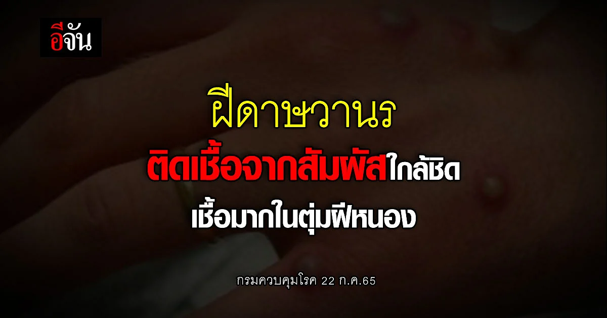 ฝีดาษวานร รายแรกในไทยสายพันธุ์แอฟริกาตะวันตก