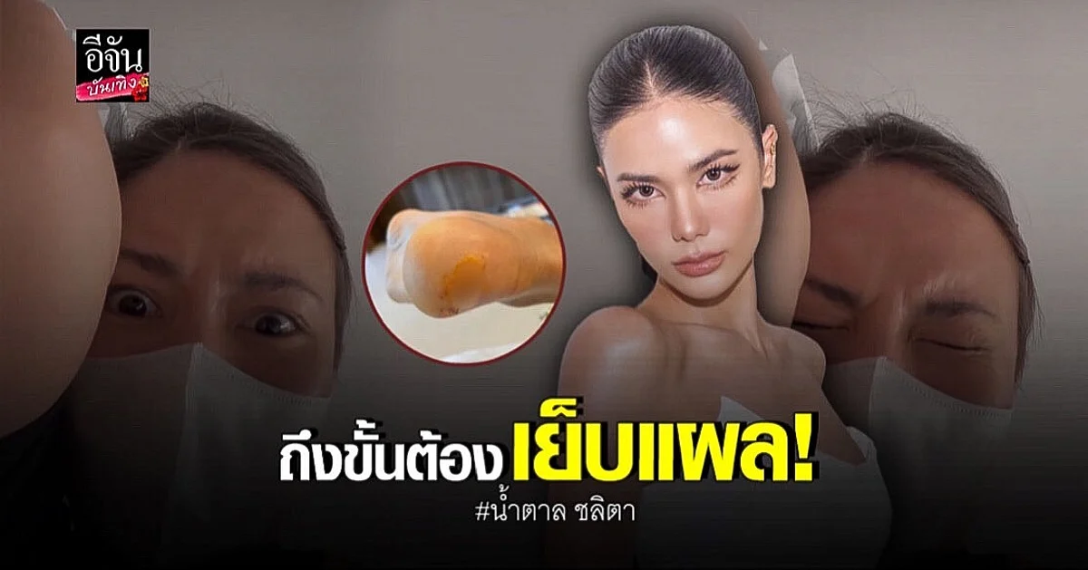 น้ำตาล ชลิตา เจ็บตัว! ถึงขั้นต้องเย็บ 5 เข็ม