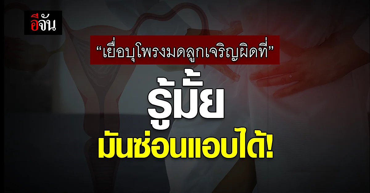 ผู้หญิงควรระวัง! เยื่อบุโพรงมดลูกเจริญผิดที่ แบบซ่อนแอบ