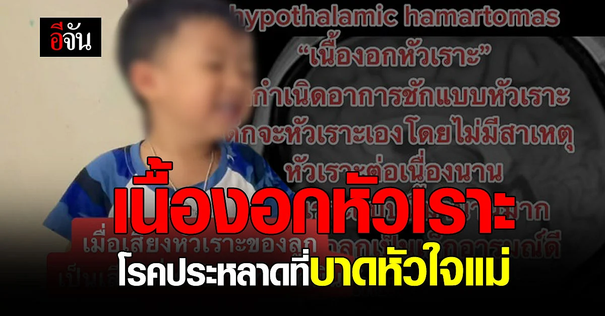 บีบหัวใจแม่! โรคประหลาด เนื้องอกหัวเราะ ลูกหัวเราะจนชัก