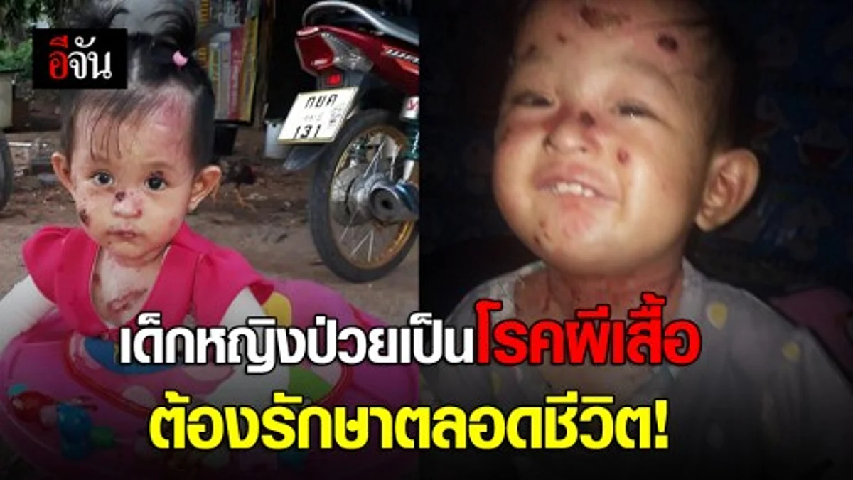 ปิดรับยอดบริจาคแล้ว! เด็กหญิงป่วยเป็นโรคผีเสื้อ