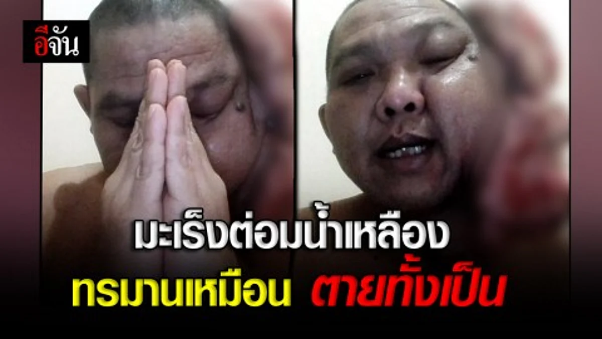 หนุ่มใหญ่ป่วย "มะเร็งต่อมน้ำเหลือง" ชนิดร้ายแรง วอนผู้ใจบุญช่วยเหลือ