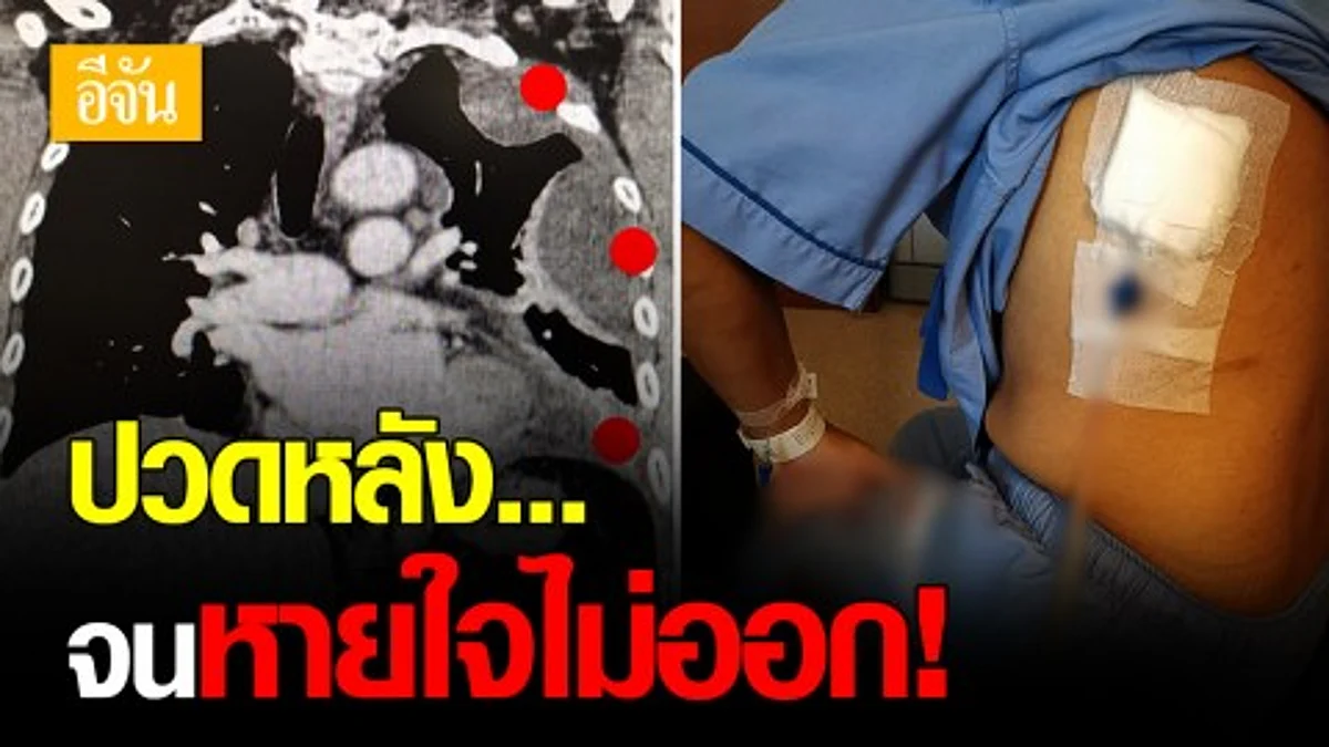 หมอโพสต์เตือน ปวดหลัง อย่าชะล่าใจ! หลังเจอผู้ป่วย ปอดติดเชื้อ-มีน้ำในเยื่อหุ้มปอด หลังปวดหลังนาน 2 สัปดาห์
