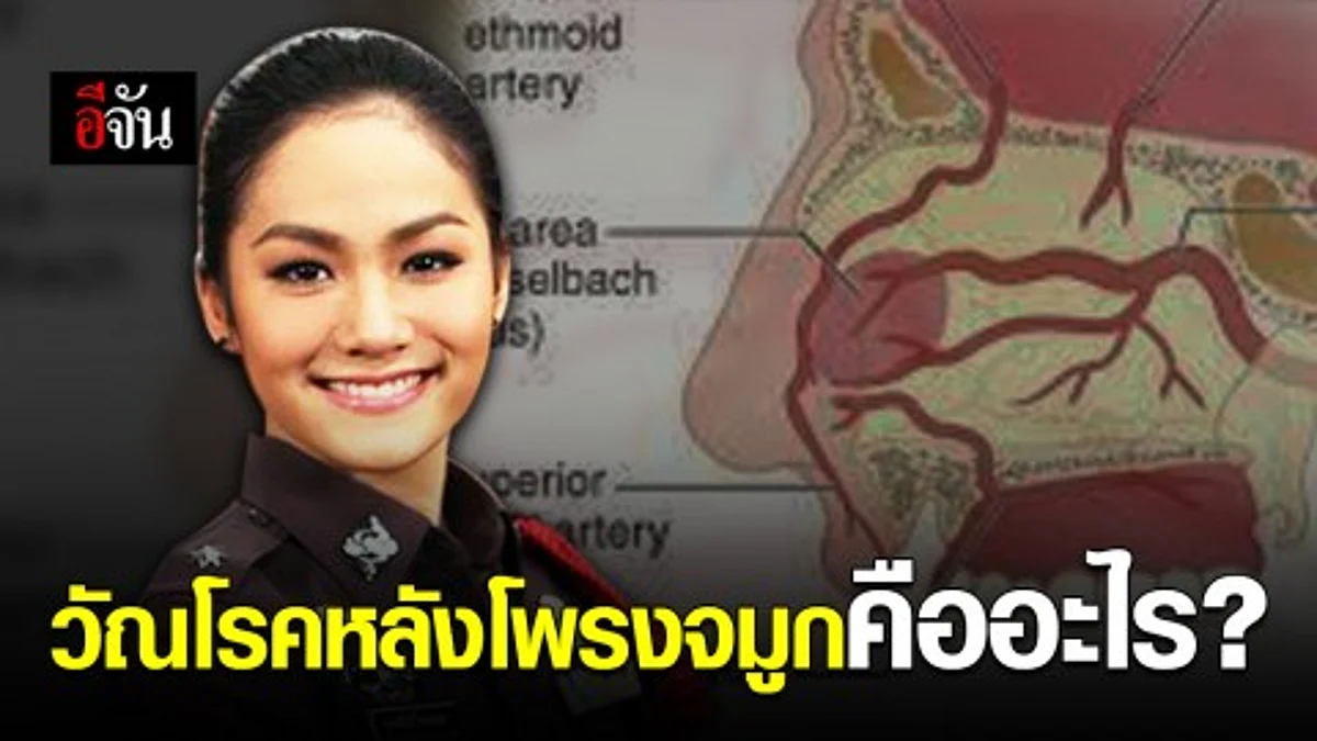 วัณโรคหลังโพรงจมูกคืออะไร