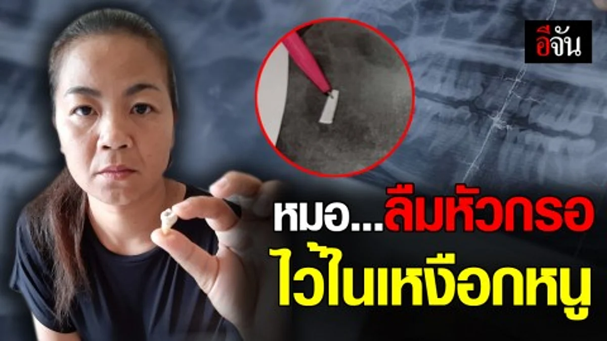 คนไข้วอนหมอ ช่วยเอาหัวกรอ ออกจากเหงือก หลังลืมไว้นาน 5 ปี ตอนนี้ชาปากลามถึงหูแล้ว