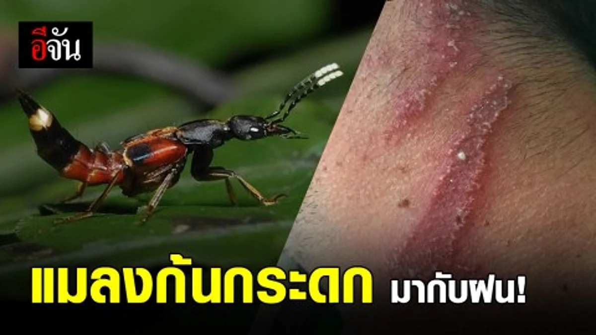 หน้าฝนจงระวัง แมลงก้นกระดก แมลงพิษที่มาพร้อมฝน