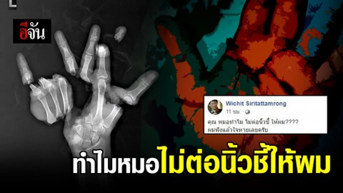 หมอโพสต์ เล่านาทีคนไข้ถาม ทำไมไม่ต่อนิ้วชี้ให้ จากคำถามกลายเป็นคำขอบคุณ