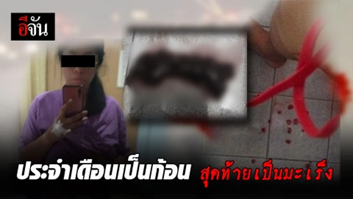 สาวเล่าประสบการณ์ ประจำเดือนเป็นก้อน สุดท้ายกลายเป็นมะเร็งเยื่อบุโพรงมดลูก
