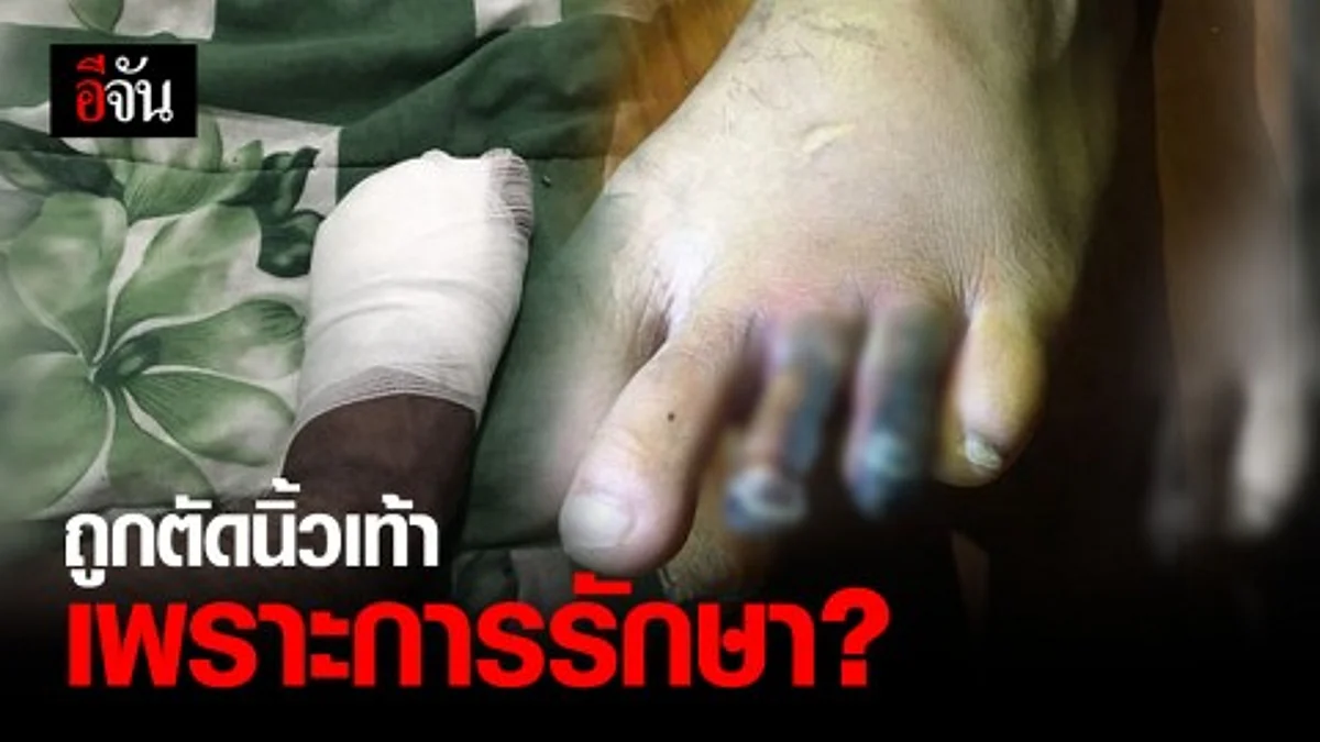 หนุ่มวัย 20 ถูกตัดนิ้วเท้า กลายเป็นคนพิการตลอดชีวิต