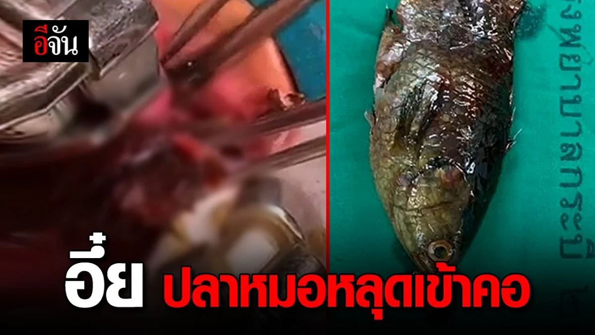 หนุ่มประมง ใช้ปากคาบปลาหมอ พลาดปลาหลุดเข้าลำคอ!
