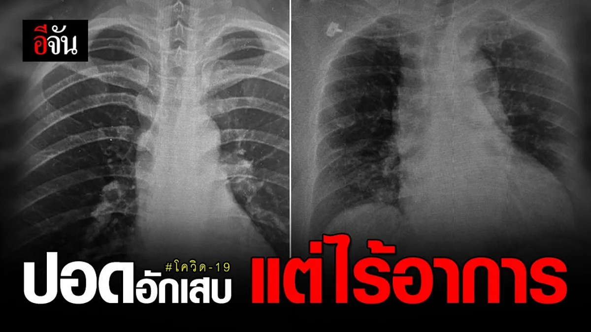 หมอเผยภาพ ฟิล์มเอกซเรย์ ปอด ของผู้ป่วย โควิด ที่ตรวจพบ ติดเชื้อโควิด แต่ไม่มีอาการ