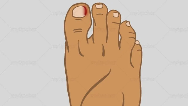Ingrown Toenail