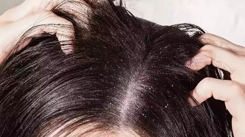 केसांमध्ये कोंडा आणि खाज होत असेल तर फॉलो करा 'या' टिप्स