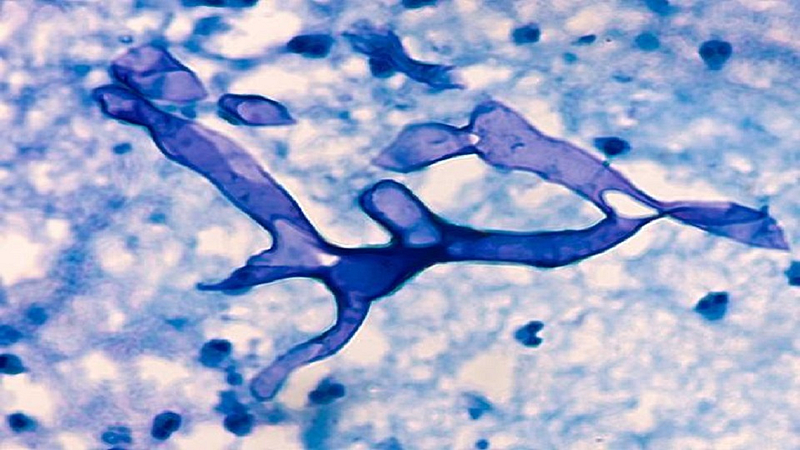 mucormycosis