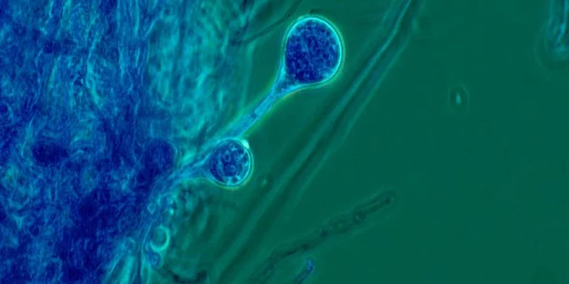 Mucormycosis