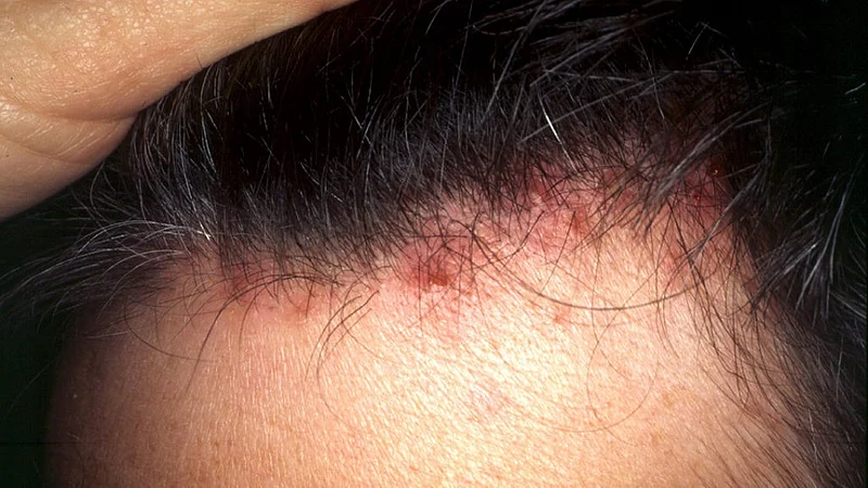 scalp