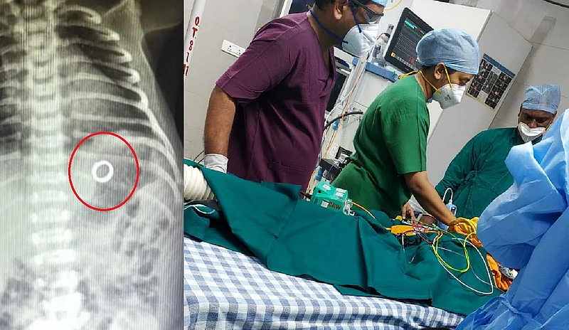 काही तासांपूर्वी जन्मलेल्या बाळानं गिळली सोन्याची अंगठी