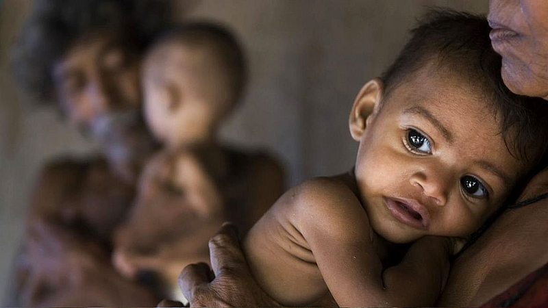 malnutrition children