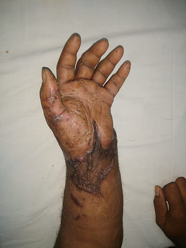 joint hand