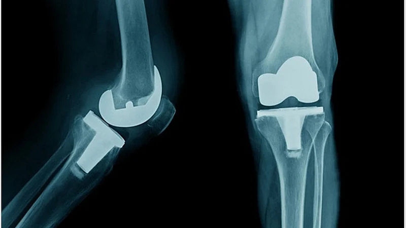 Knee Replacement