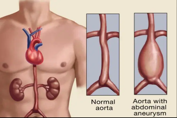 abdominal aortic aneurysm (AAA) या महाधमनीमध्ये फुगवटा किंवा सूज आहे, मुख्य रक्तवाहिनी जी हृदयापासून छाती आणि पोटातून खाली जाते.