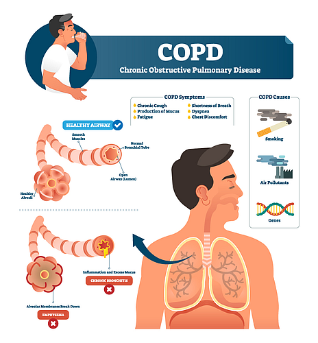 COPD Decease