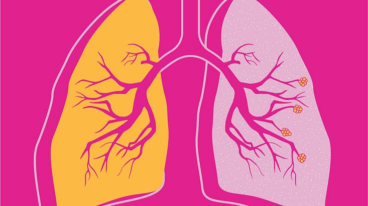 तंबाखूचे सेवन, चुलीवरील स्वयंपाकामुळे COPD चा धोका वाढला