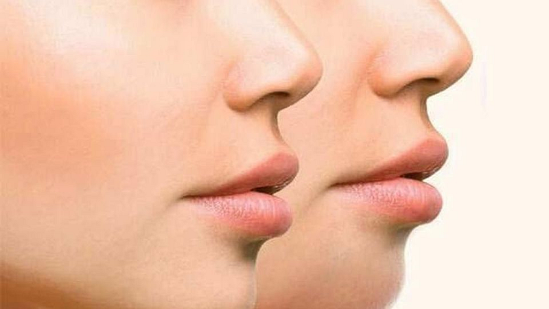 Facial Fat Reducing