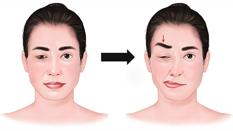 hemifacial spasm