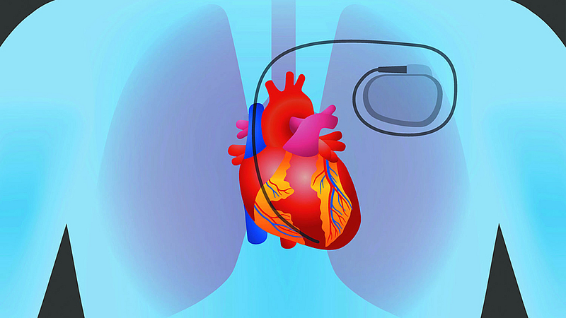 Pacemaker
