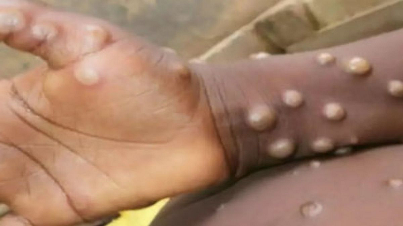 health news Five WHO Remedies Against Monkey Pox corona delhi