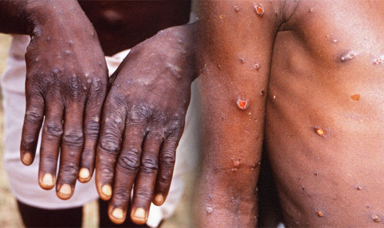 Monkeypox