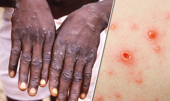 US Reported First Monkeypox Case